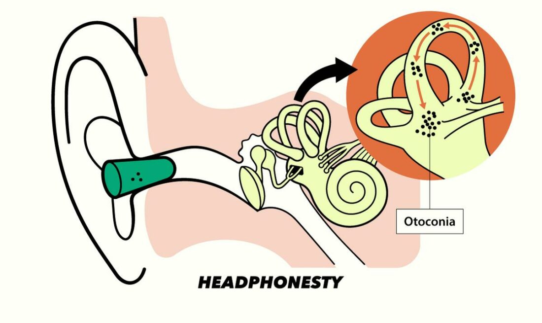How earplugs cause Benign Paroxysmal Positional Vertigo (BPPV)